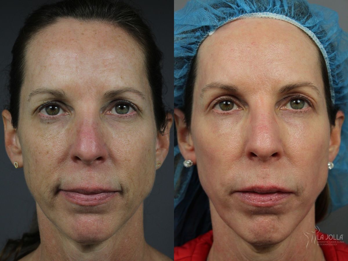 Before and after Sculptra® case 36363