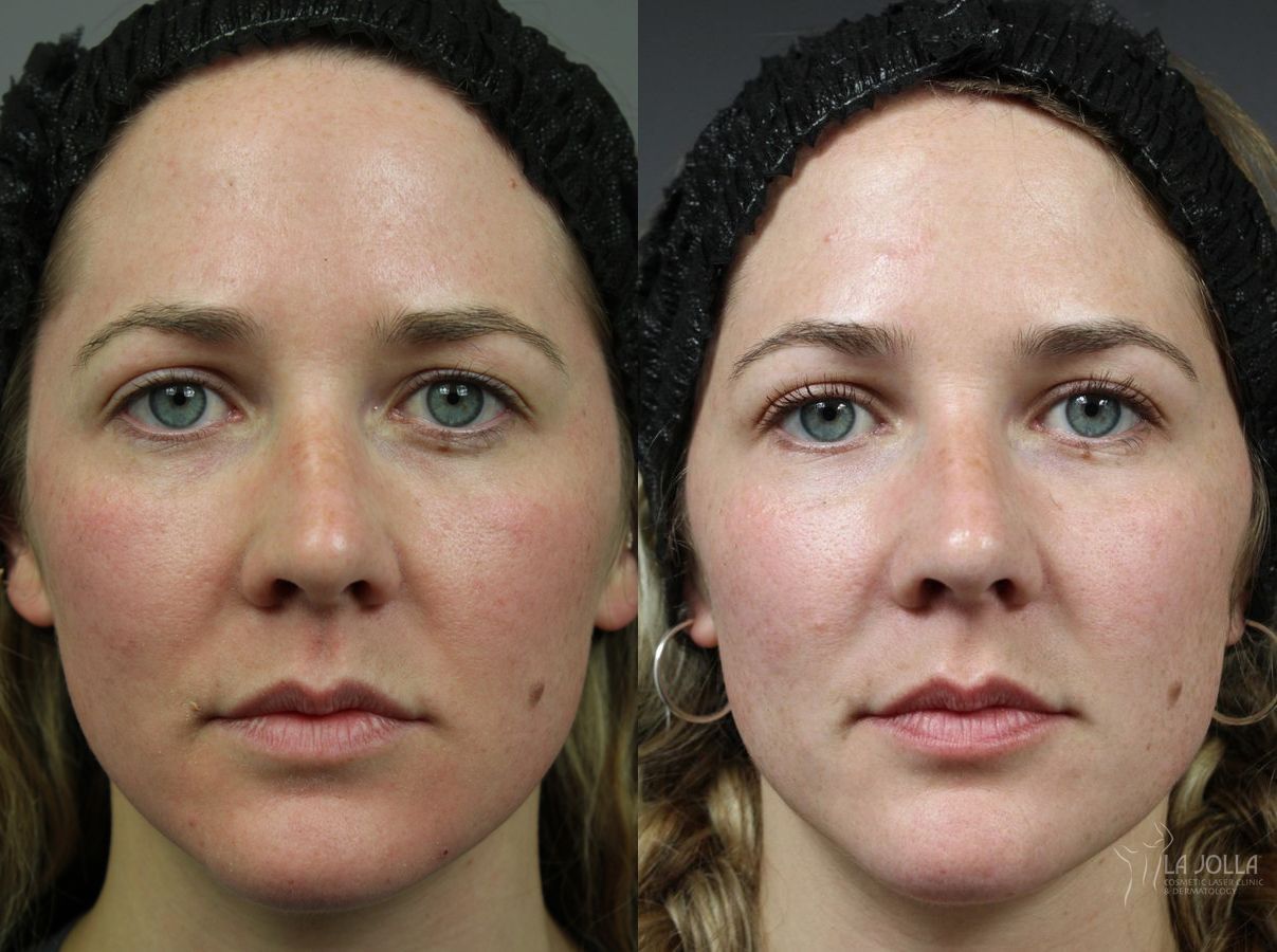 Before and after Sculptra® case 36072