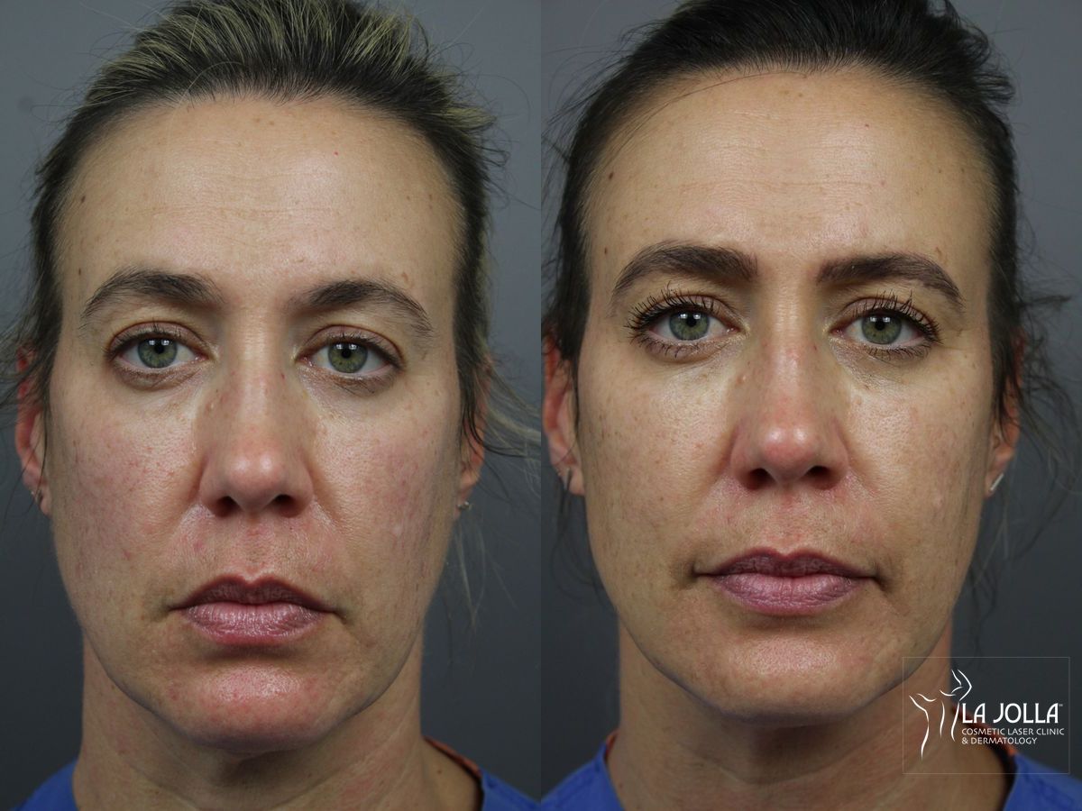Before and after Sculptra® case 36334