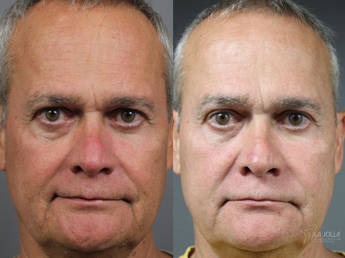 Before and after Sculptra® case 36264