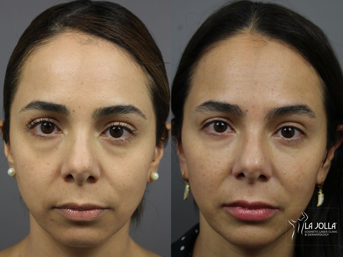 Before and after Sculptra® case 36341