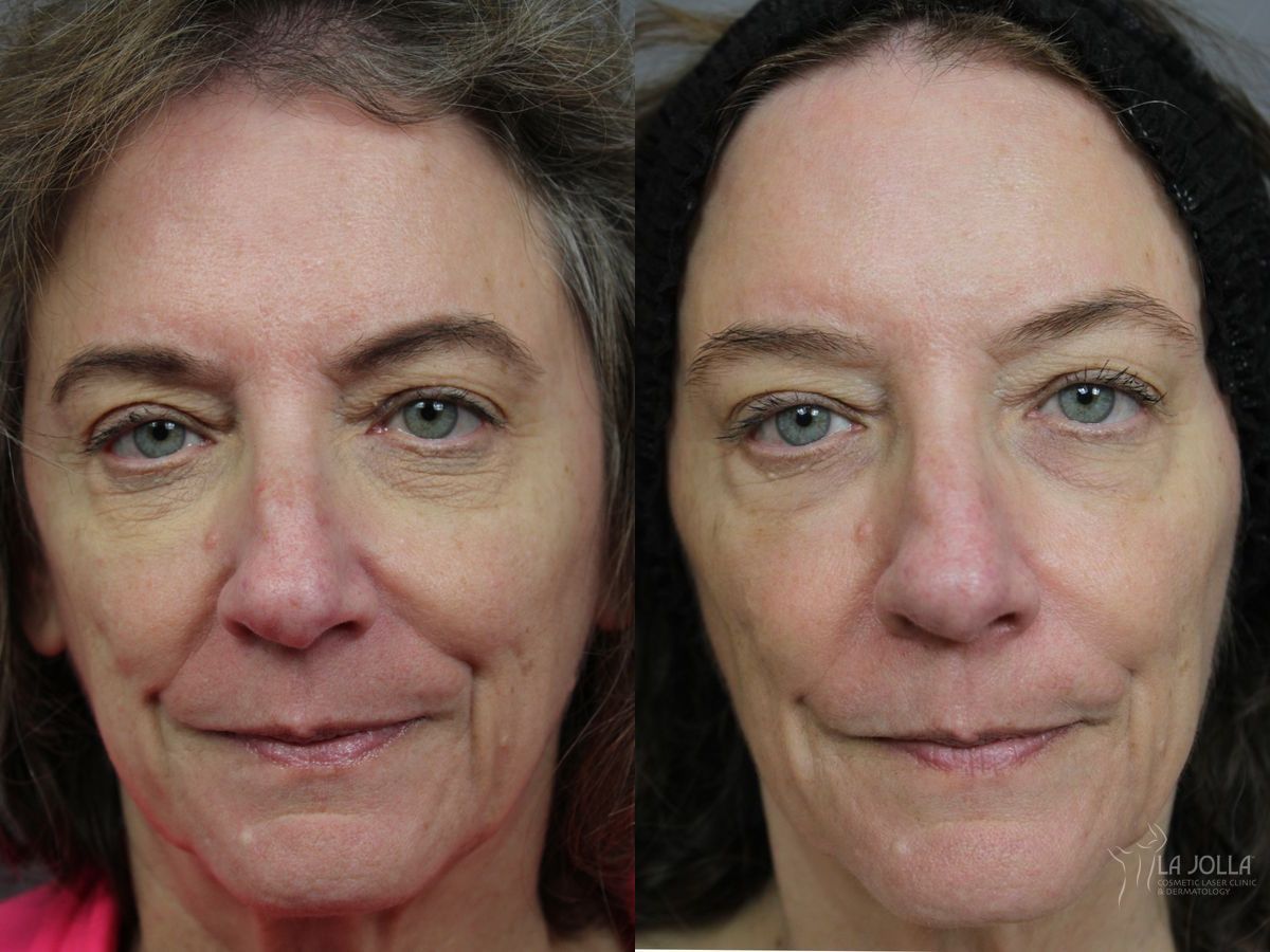 Before and after Sculptra® case 46322