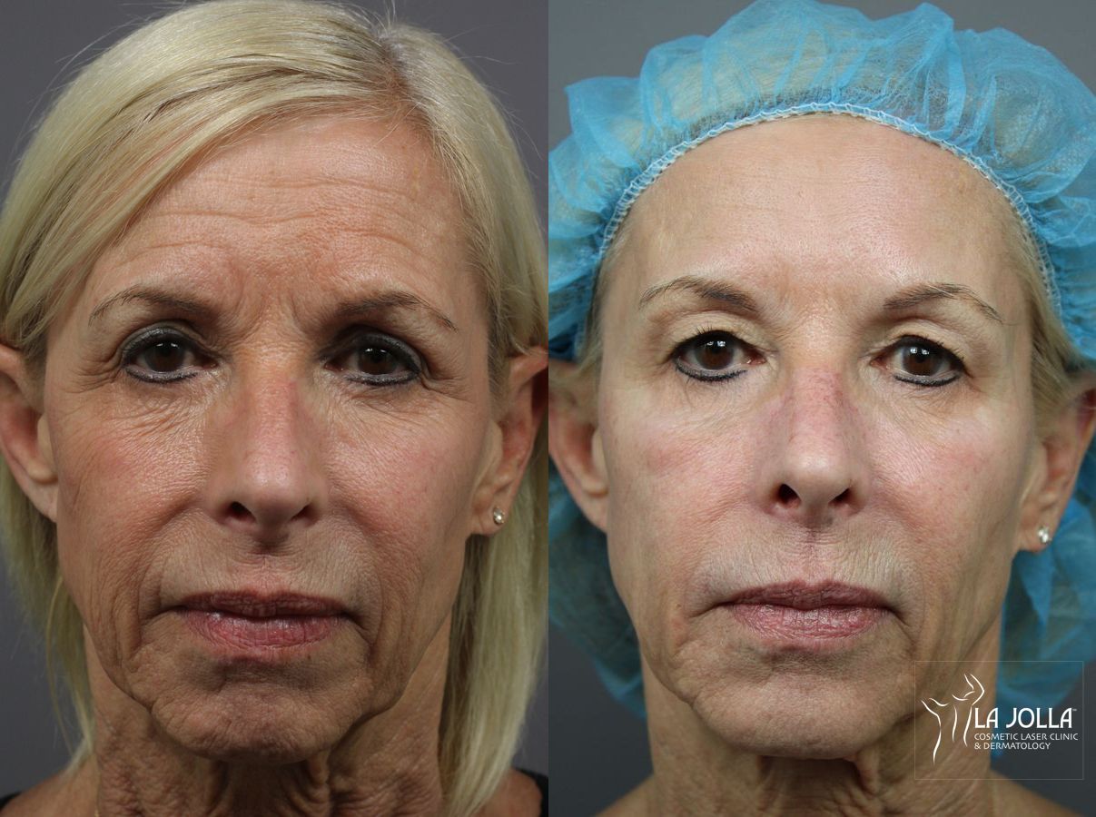 Before and after Sculptra® case 36328
