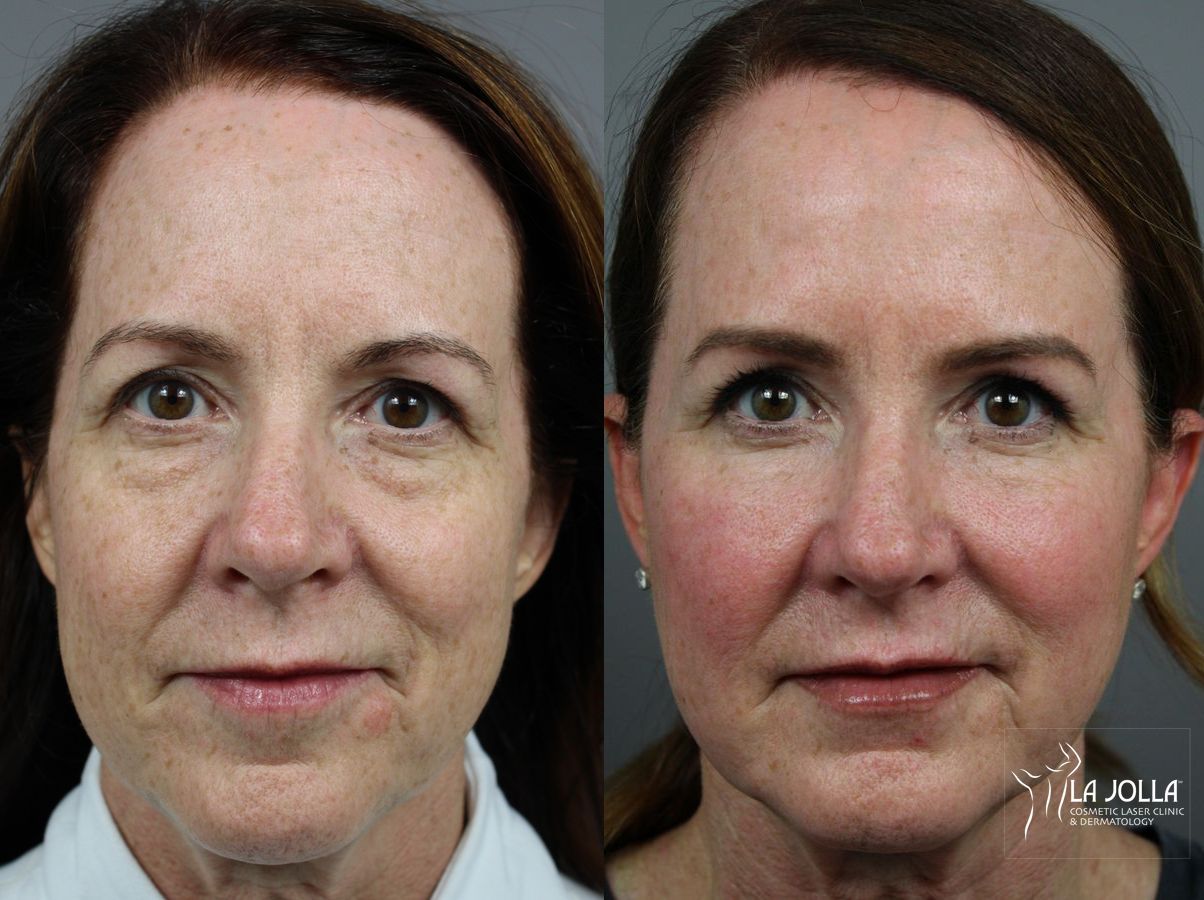 Before and after Sculptra® case 36296