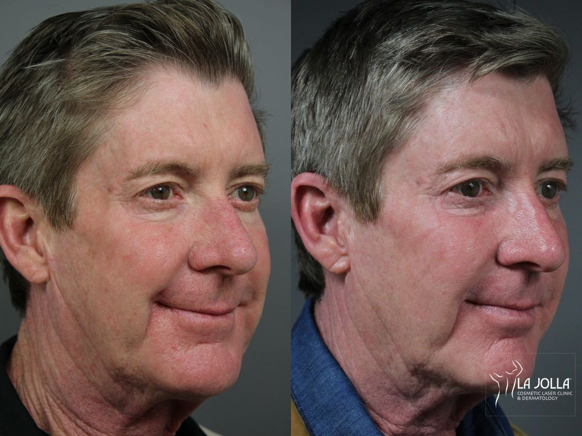 Before and after Sculptra® case 36140 - Angle 3