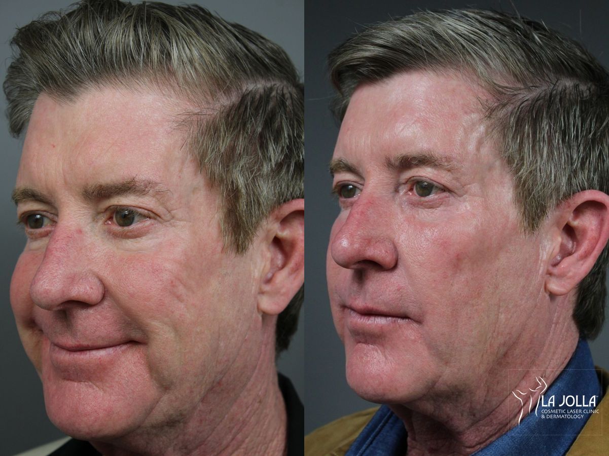 Before and after Sculptra® case 36140 - Angle 2