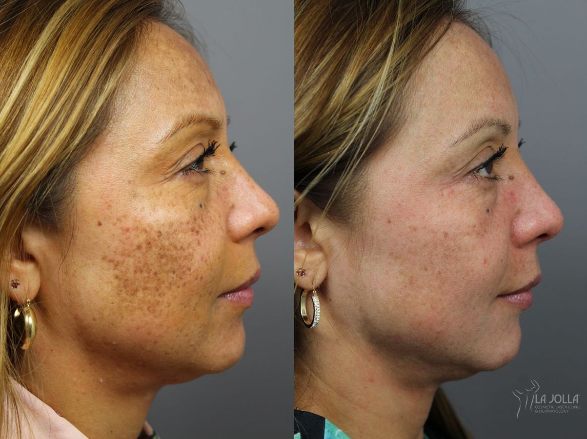 Before and after Skin Care Products case 36403