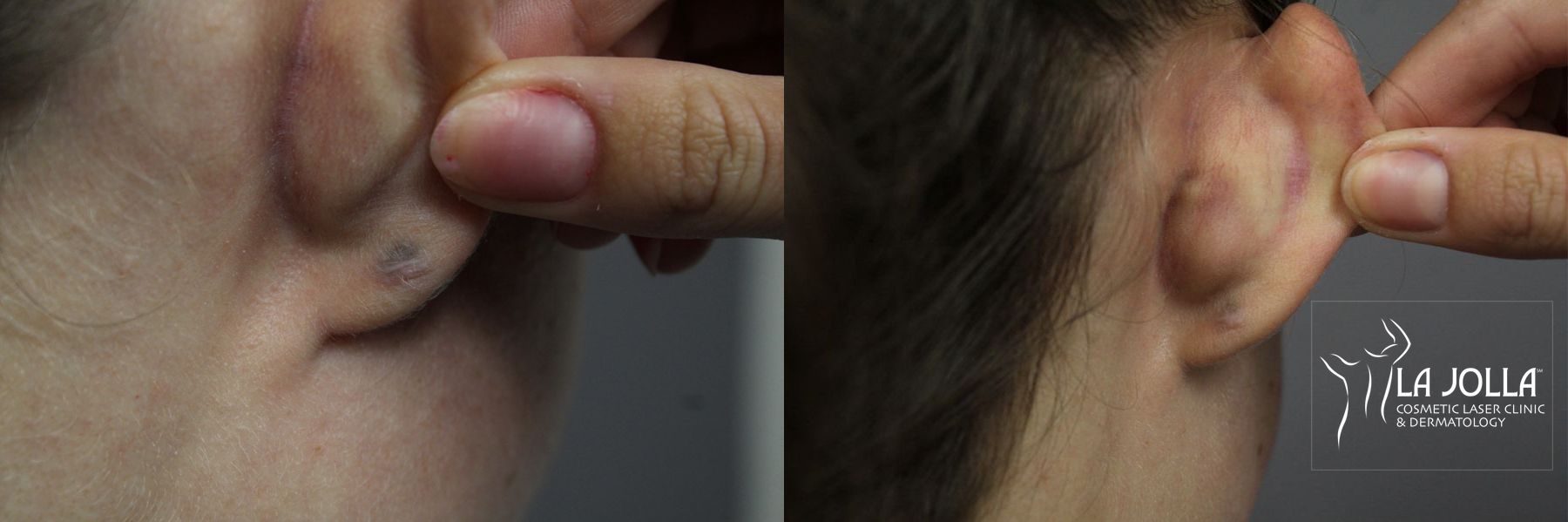 Before and after StarWalker® Laser case 36112 - Angle 2