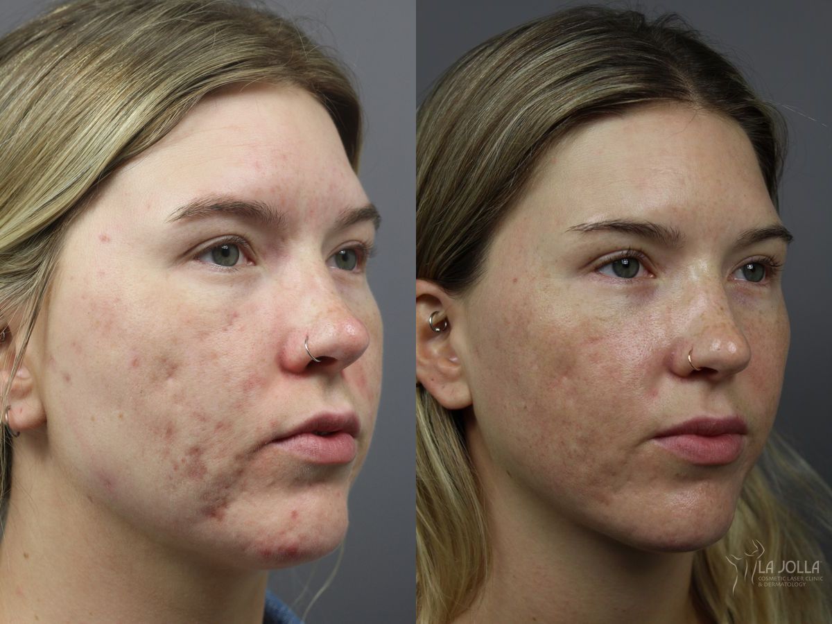 Before and after StarWalker® Laser case 36274