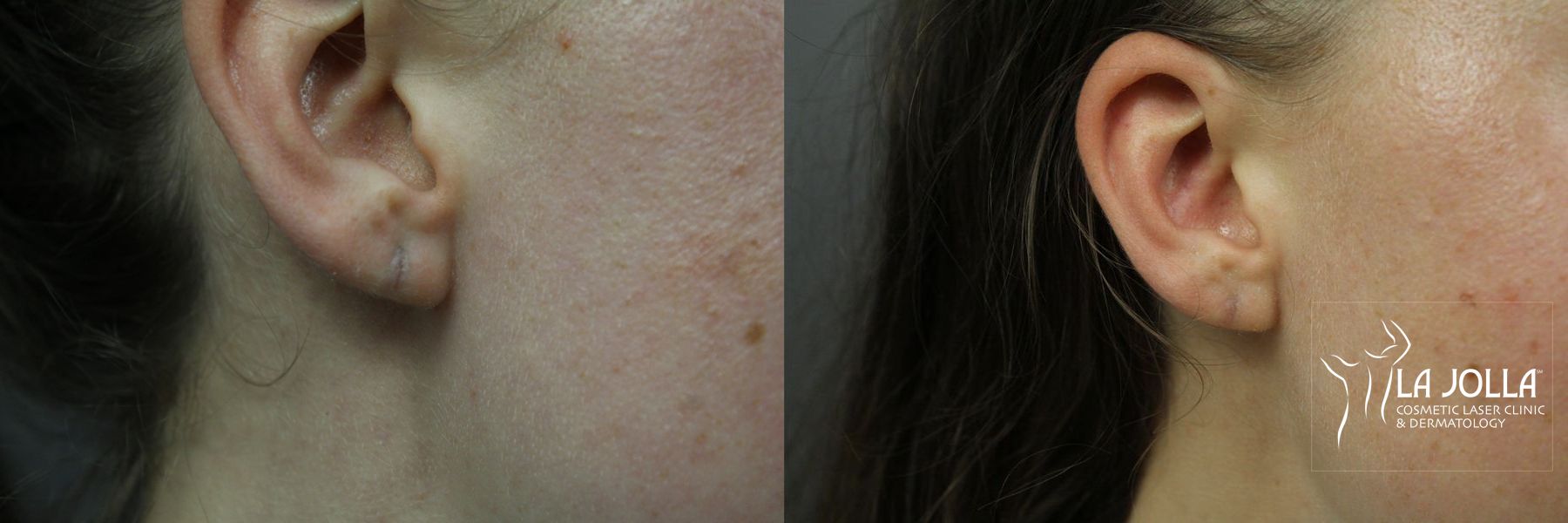 Before and after StarWalker® Laser case 36112