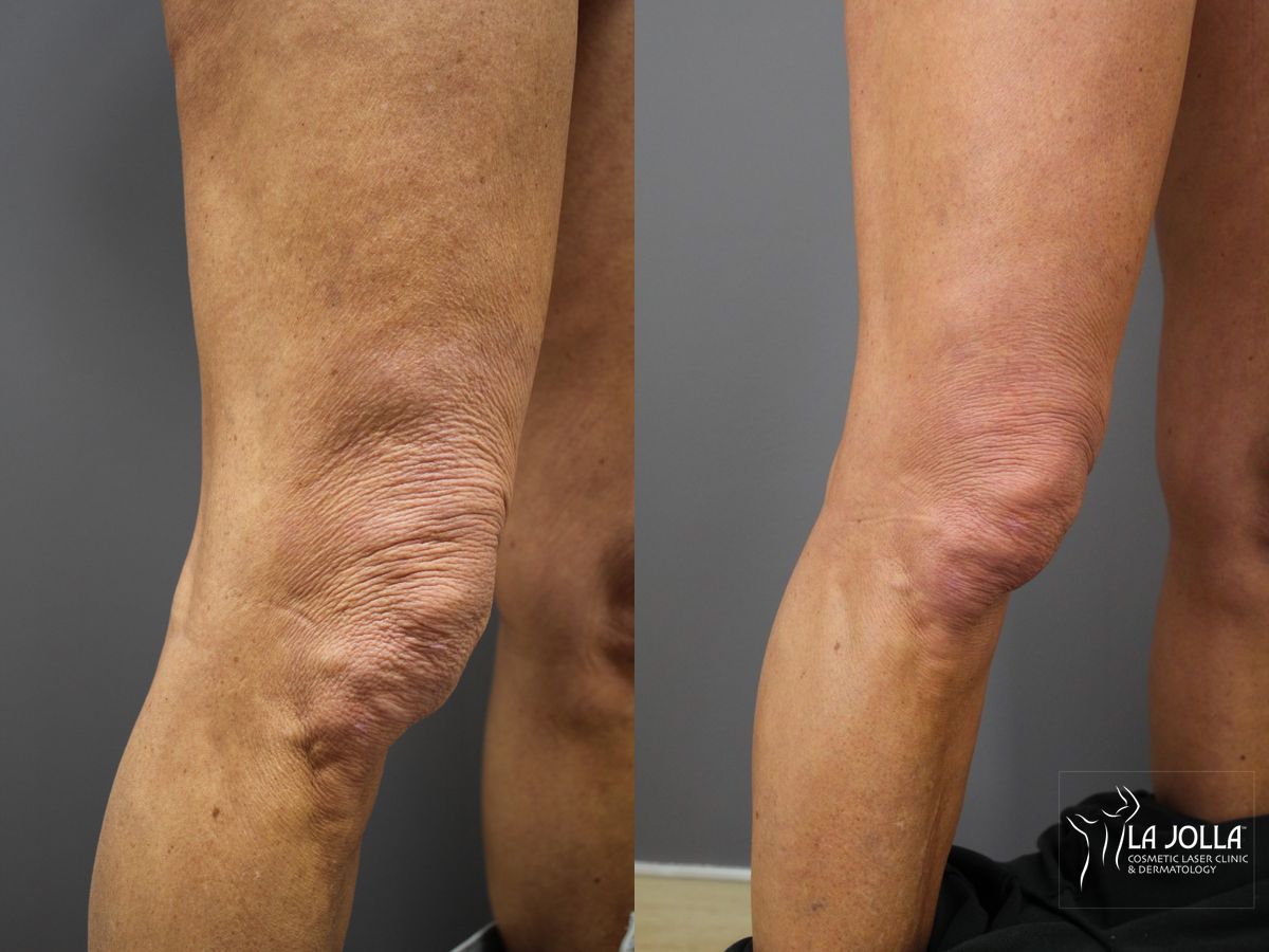 Before and after StarWalker® Laser case 36191