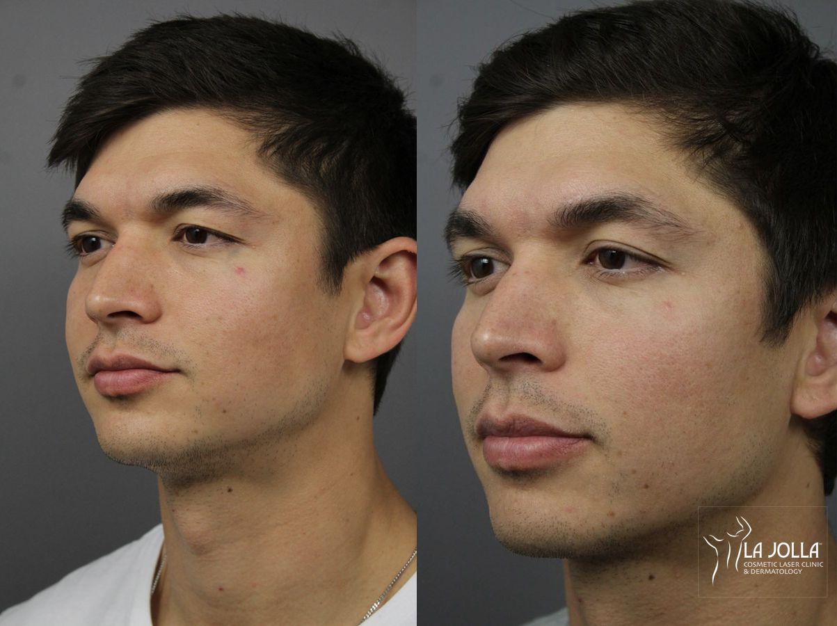 Before and after StarWalker® Laser case 36128