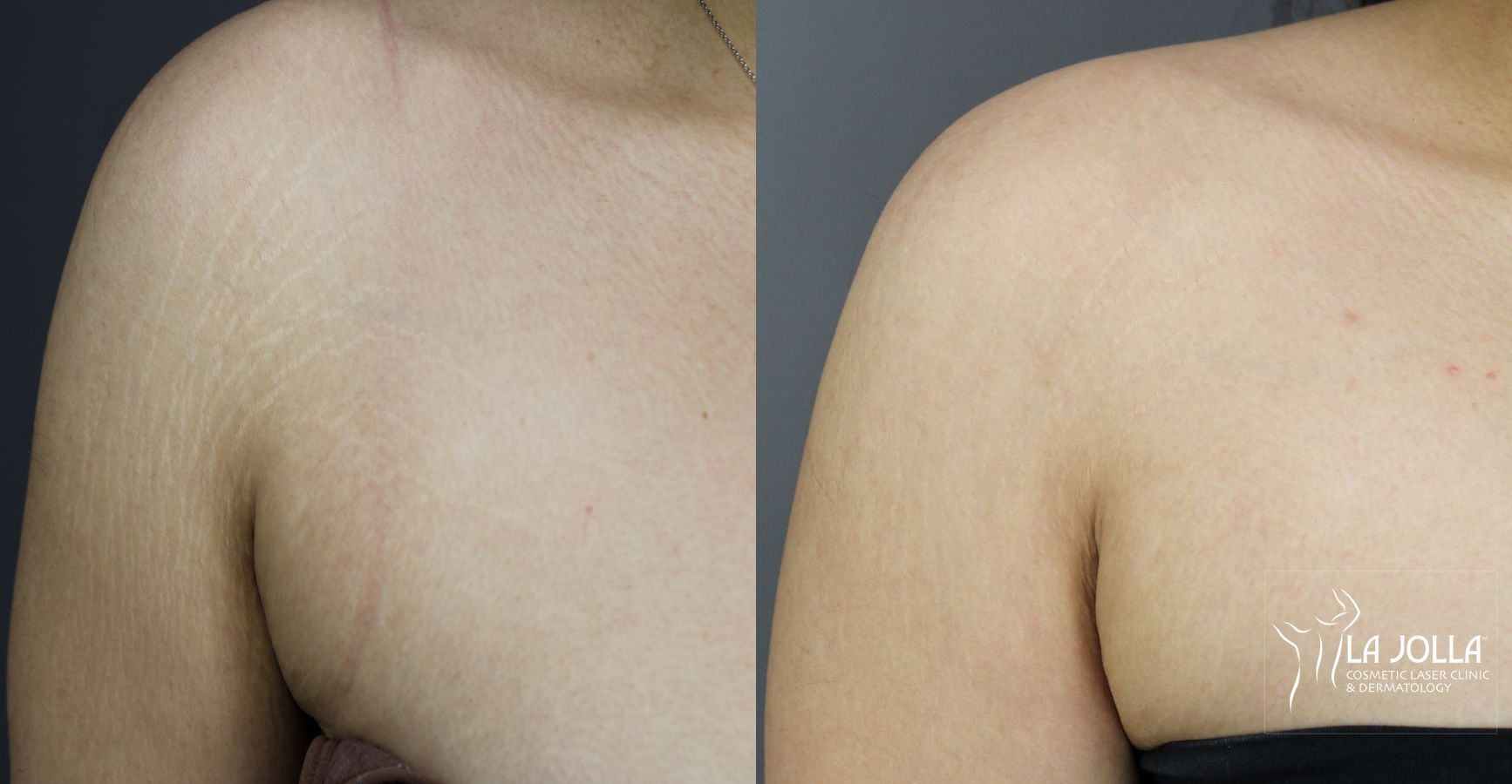 Before and after StarWalker® Laser case 36079 - Angle 2