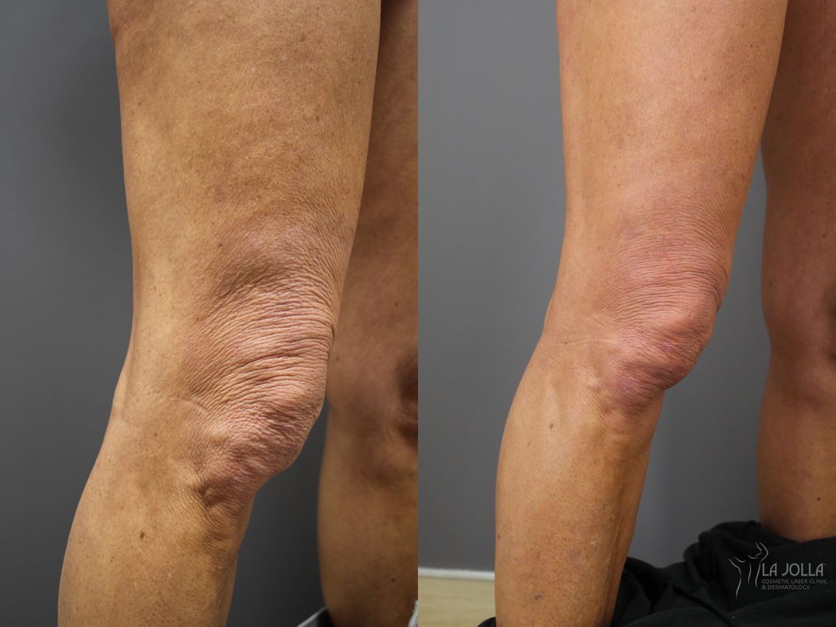 Before and after StarWalker® Laser case 36191