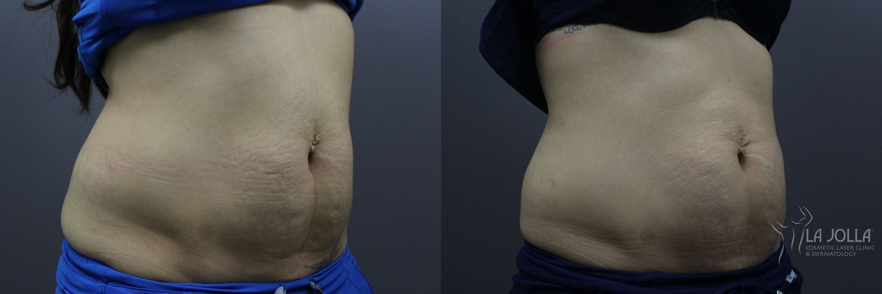 Before and after StarWalker® Laser case 36235