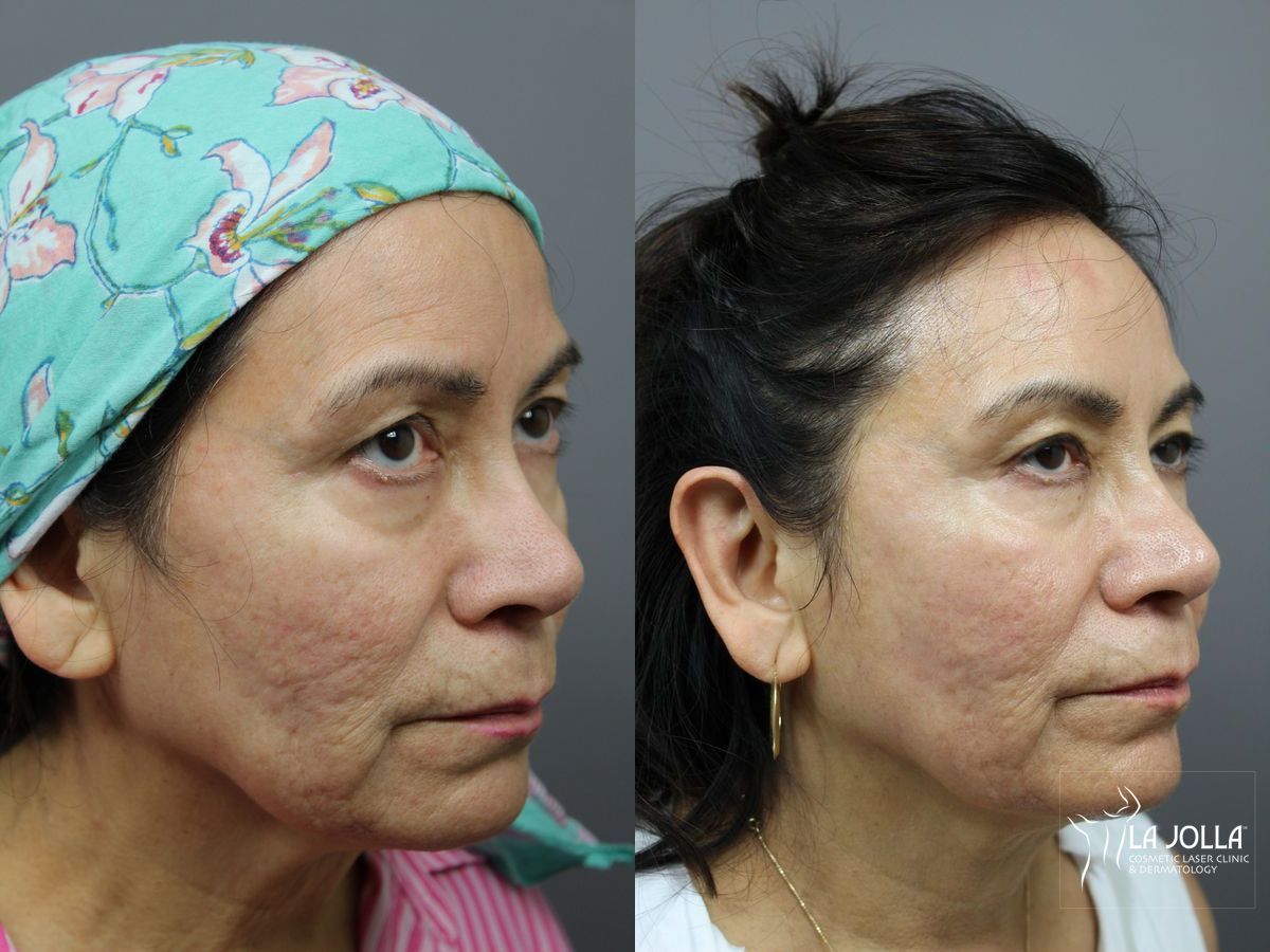 Before and after StarWalker® Laser case 36292