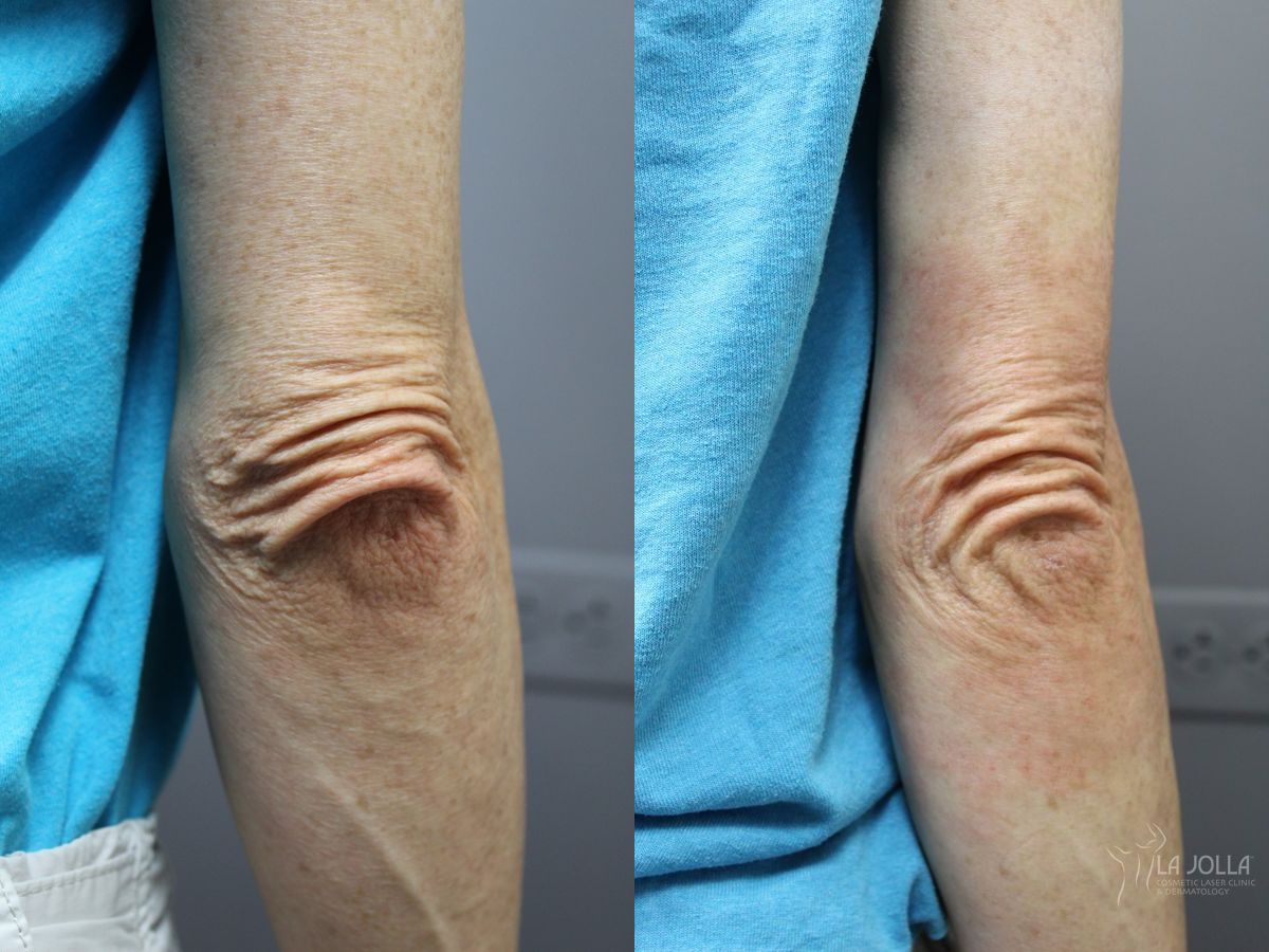 Before and after StarWalker® Laser case 36230