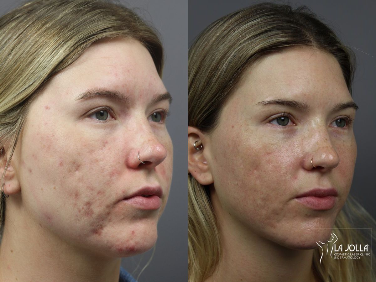 Before and after StarWalker® Laser case 36274