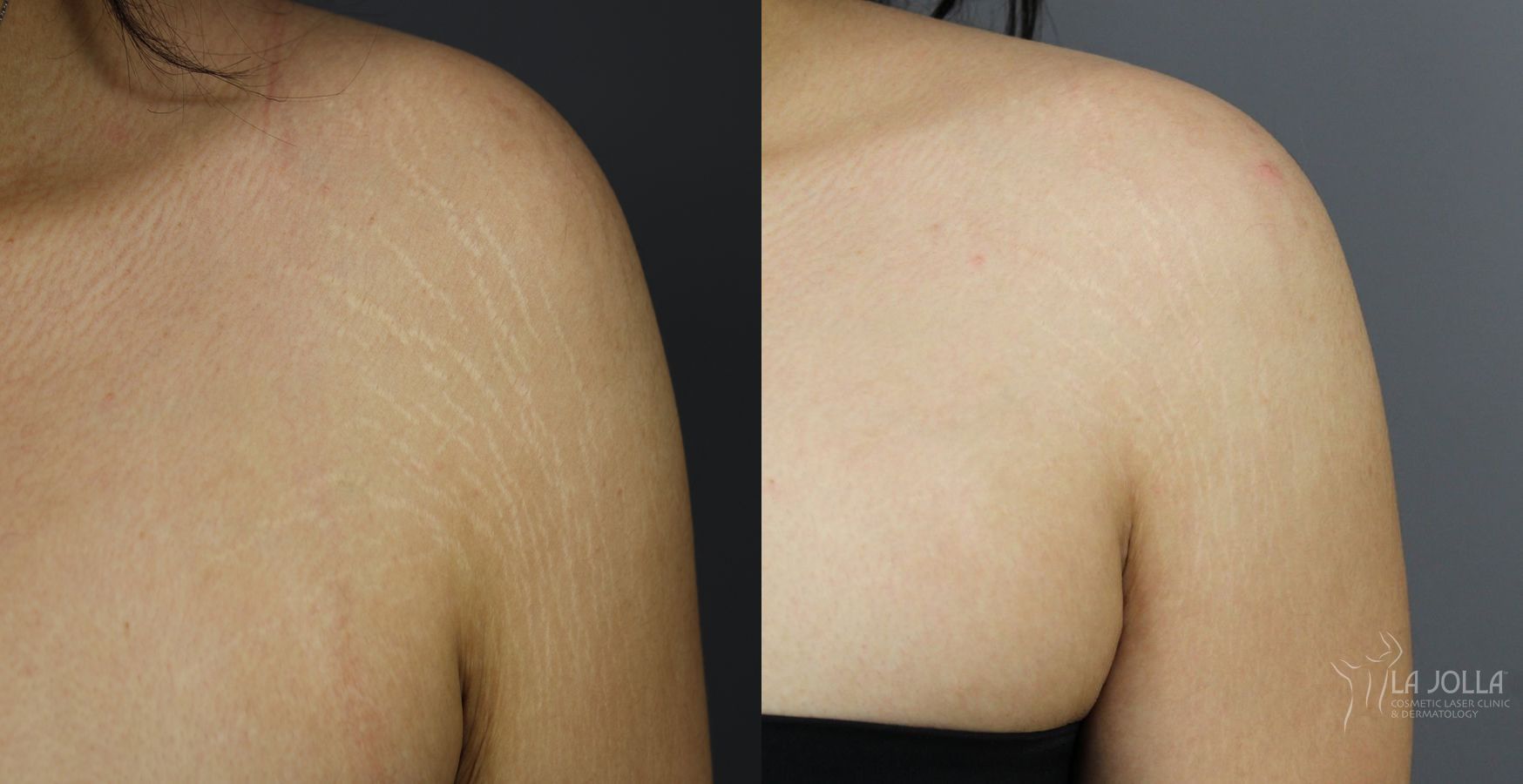 Before and after Stretch Mark case 36079