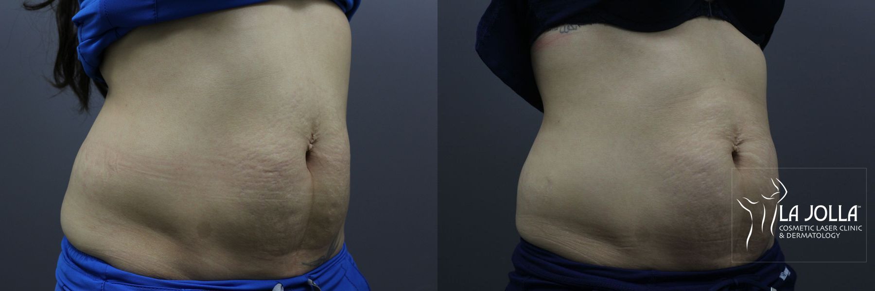 Before and after StarWalker® Laser case 36235