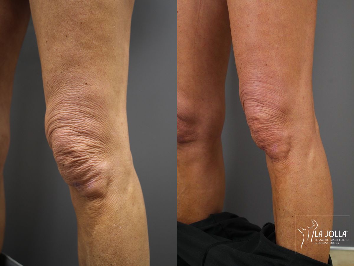 Before and after StarWalker® Laser case 36211