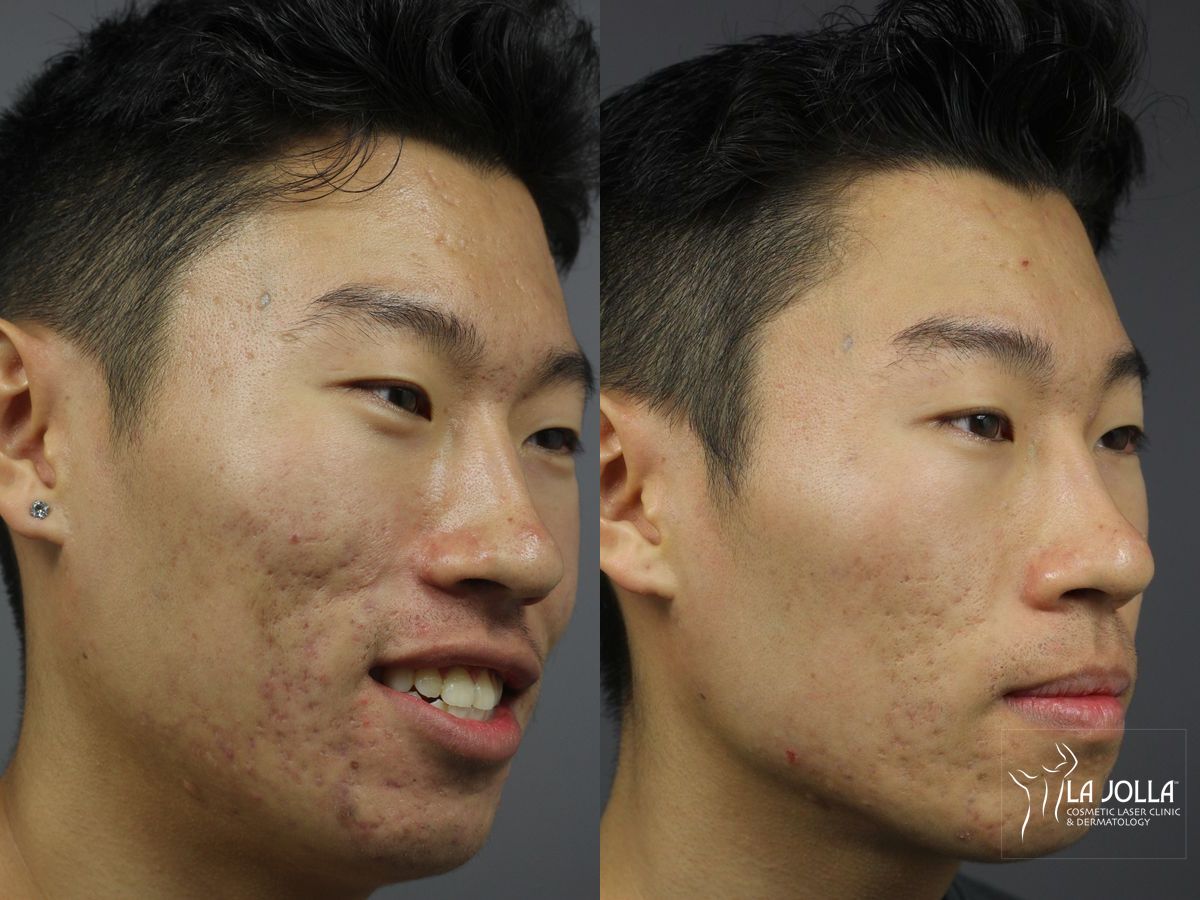 Before and after StarWalker® Laser case 36152