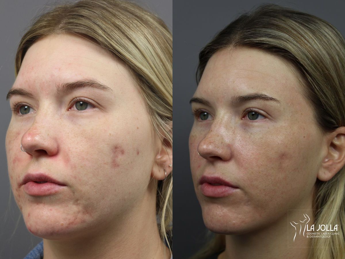Before and after StarWalker® Laser case 36271