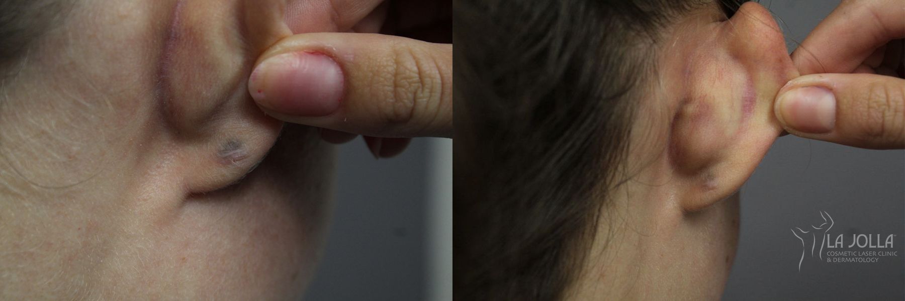 Before and after StarWalker® Laser case 36112 - Angle 2