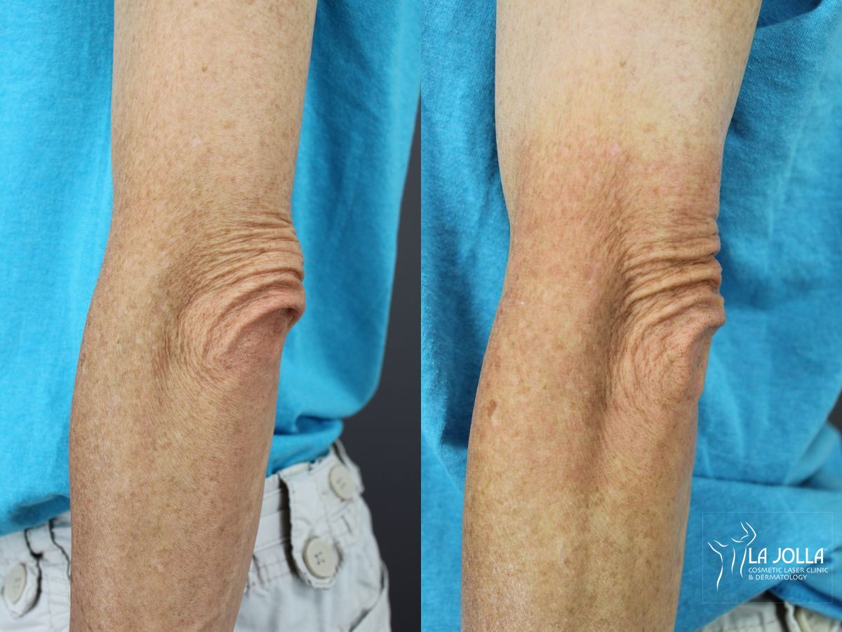 Before and after StarWalker® Laser case 36258