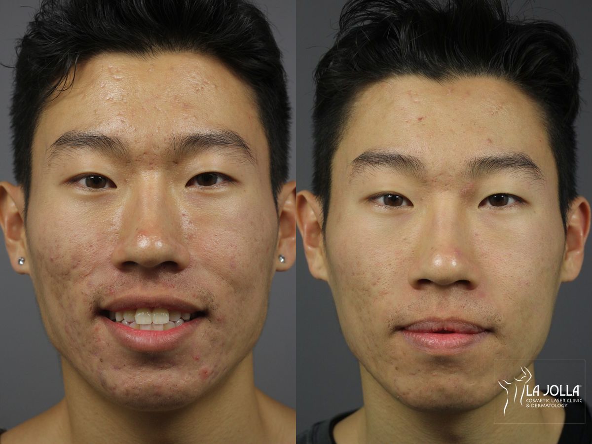 Before and after StarWalker® Laser case 36170