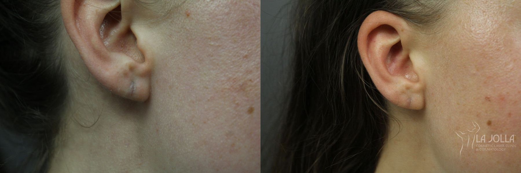 Before and after StarWalker® Laser case 36112