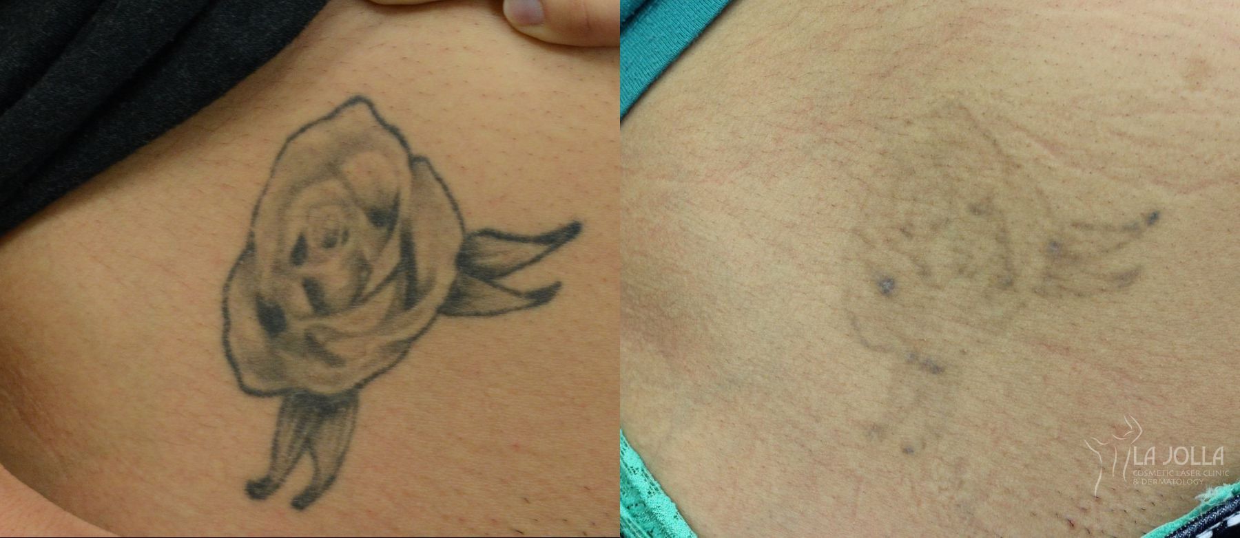 Before and after Tattoo Removal case 36424