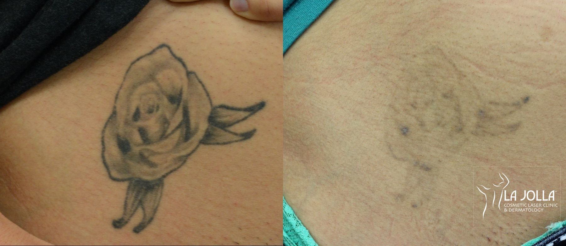 Before and after Tattoo Removal case 36424