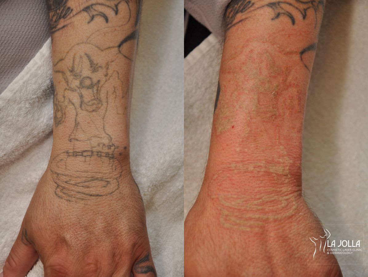 Before and after Tattoo Removal case 36388