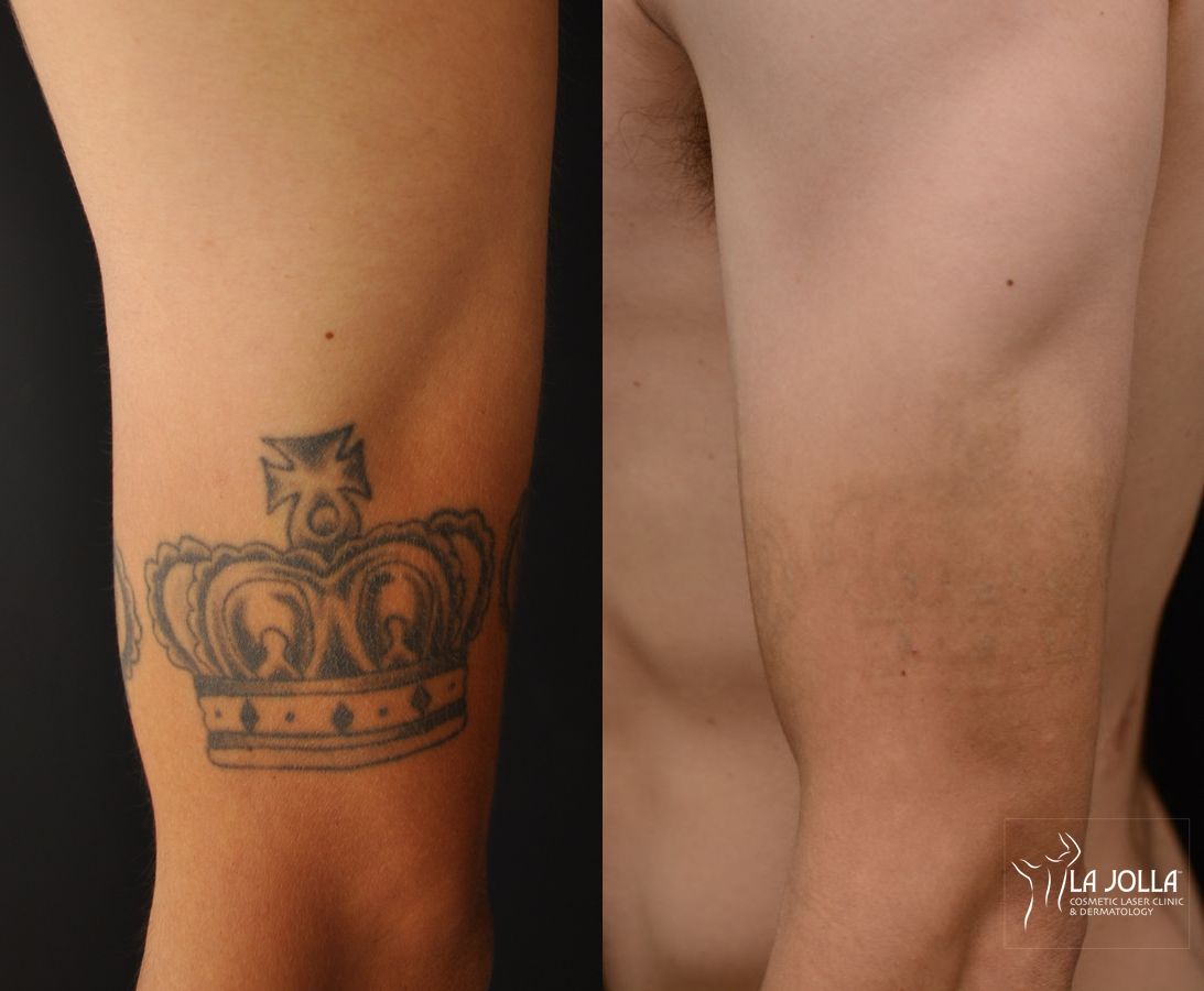 Before and after Tattoo Removal case 36406