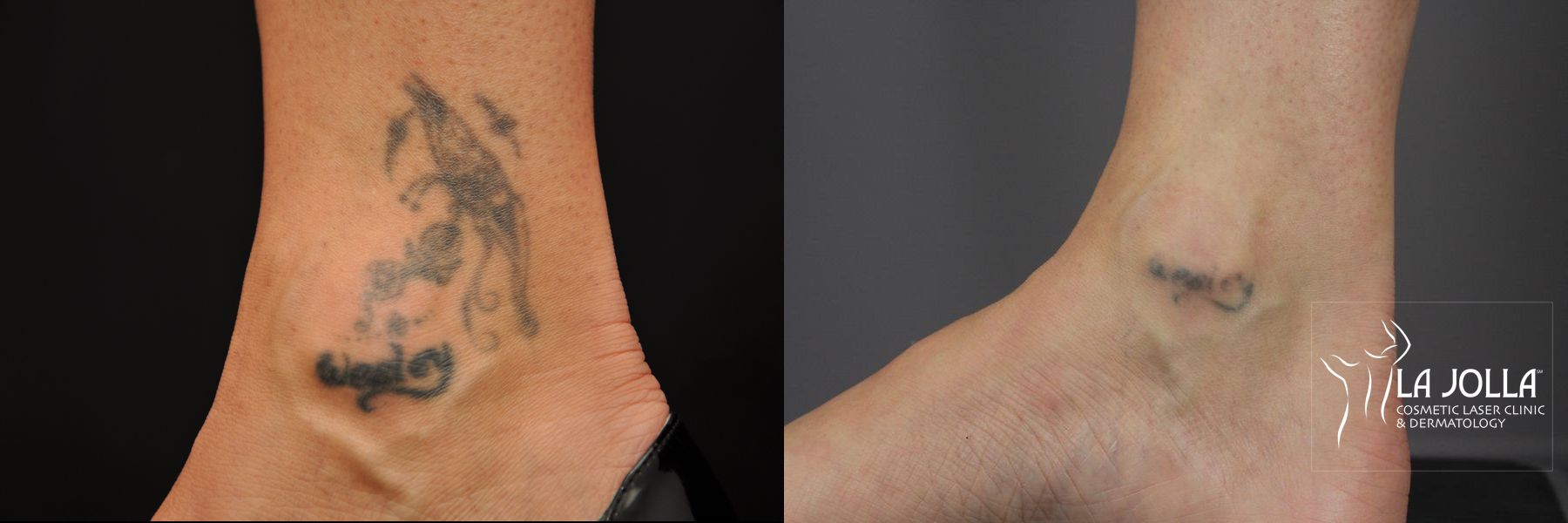Before and after Tattoo Removal case 36405