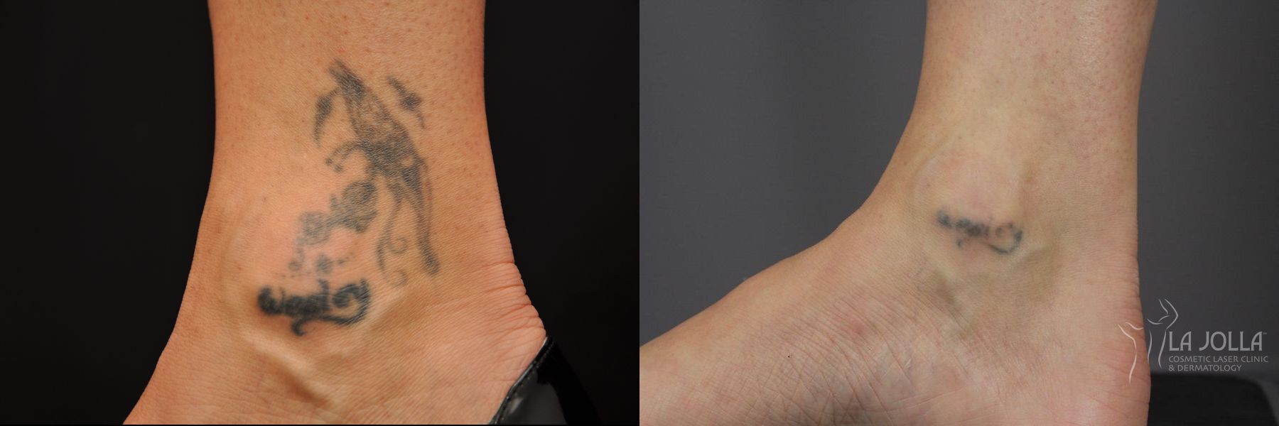 Before and after Tattoo Removal case 36405