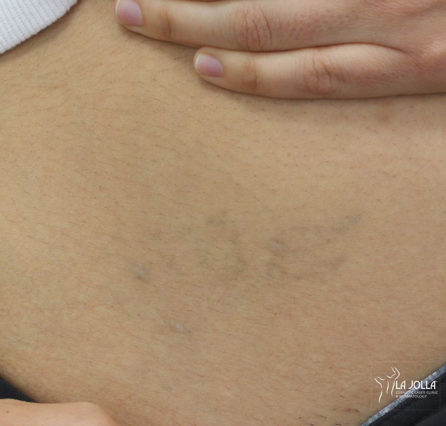 Before and after Tattoo Removal case 36424 - Angle 2
