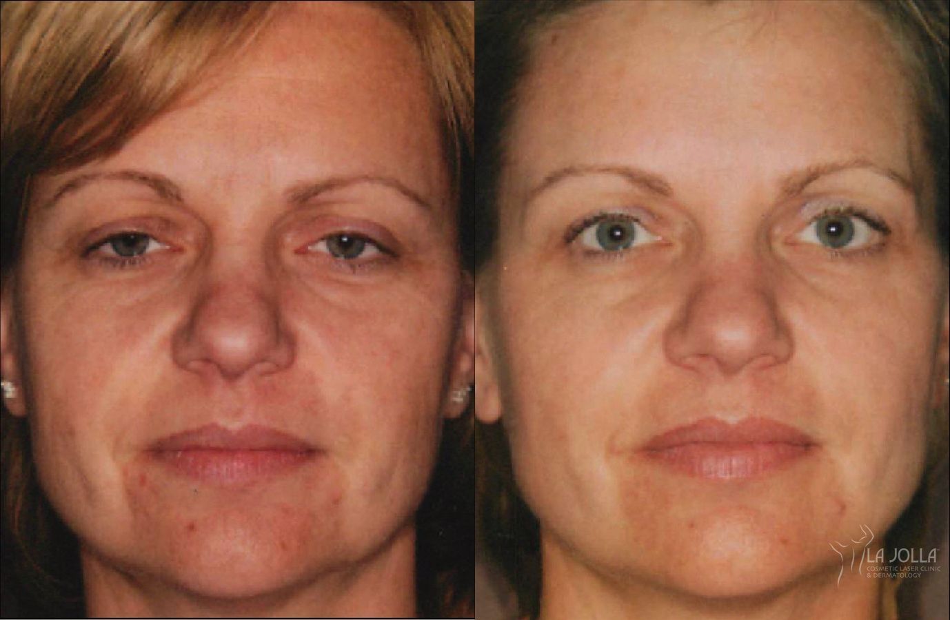 Before and after Thermage case 36068