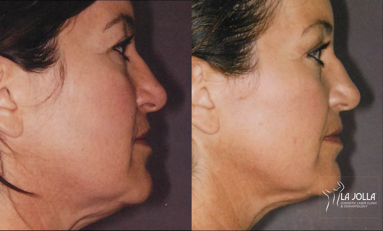 Before and after Thermage case 36226