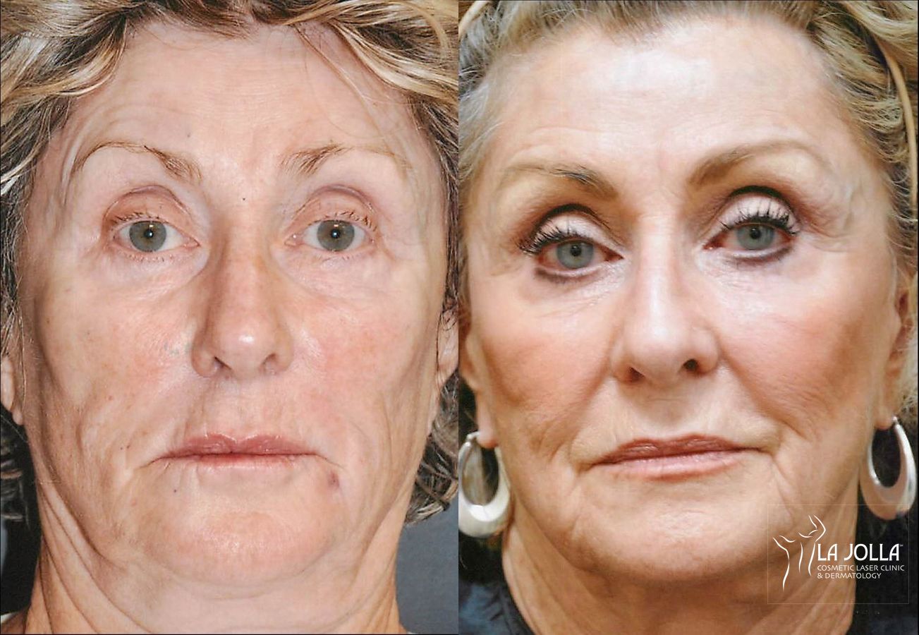 Before and after Thermage case 36250