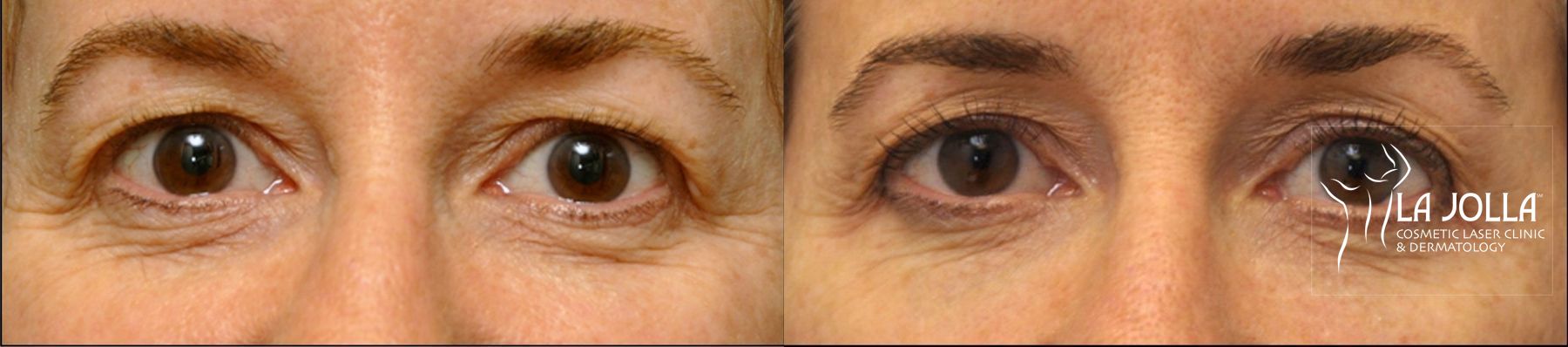 Before and after Thermage case 36126