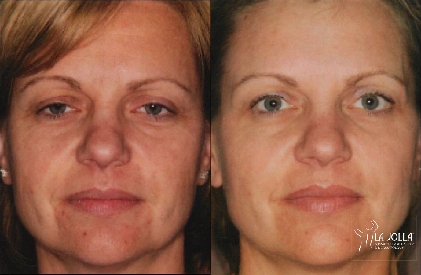 Before and after Thermage case 36068