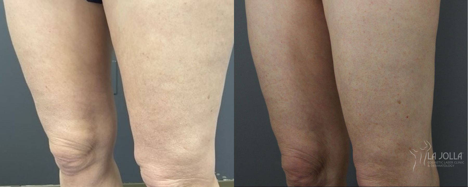 Before and after Thermage case 36159 - Angle 2