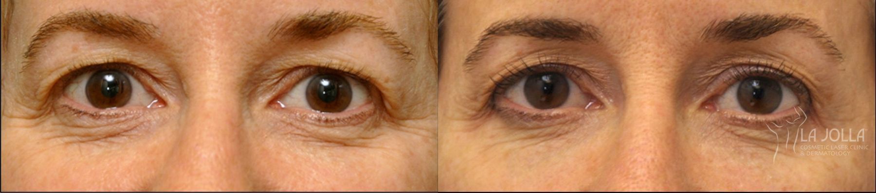 Before and after Thermage case 36126