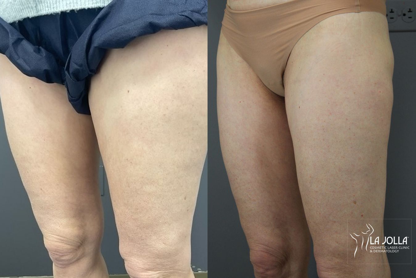 Before and after Thermage case 36159 - Angle 2