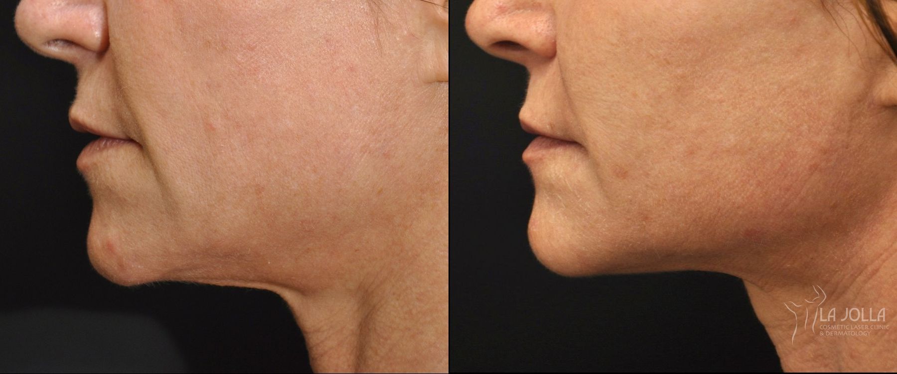 Before and after Thermage case 36265