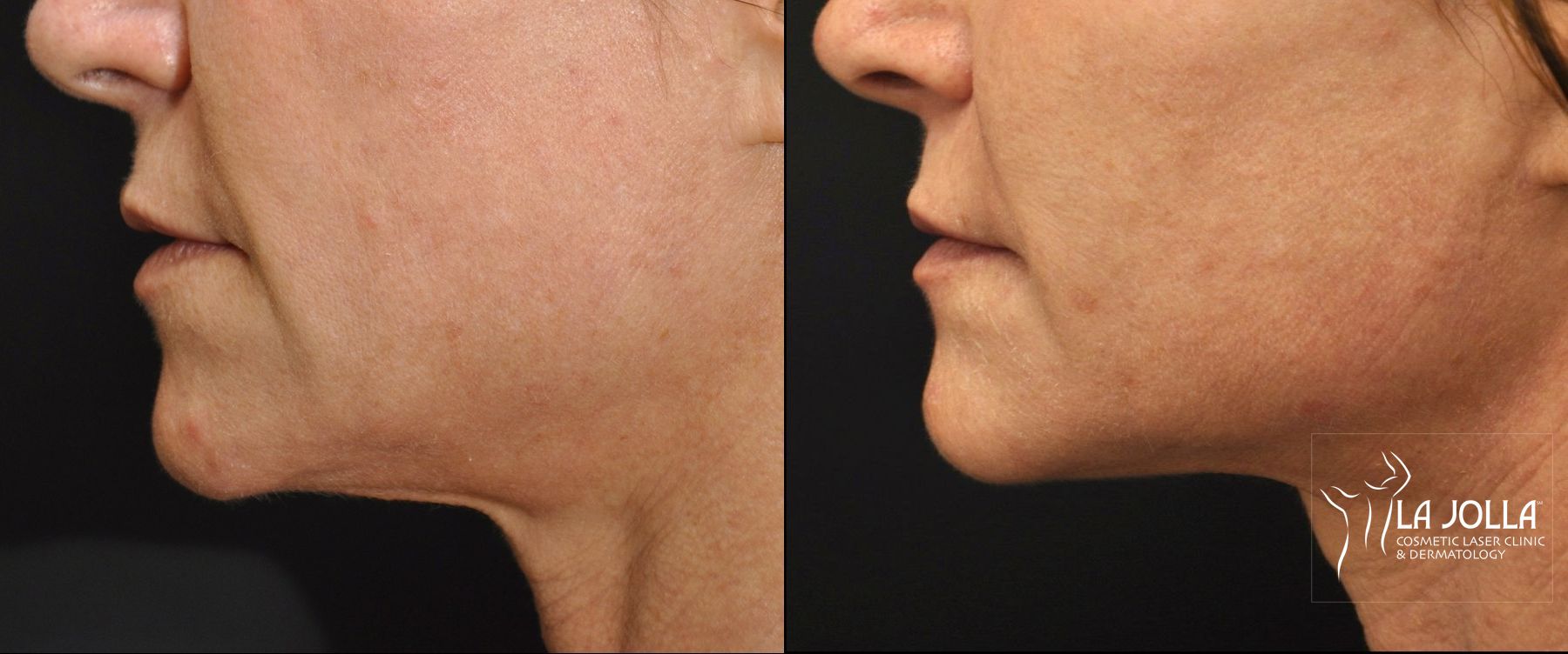 Before and after Thermage case 36265