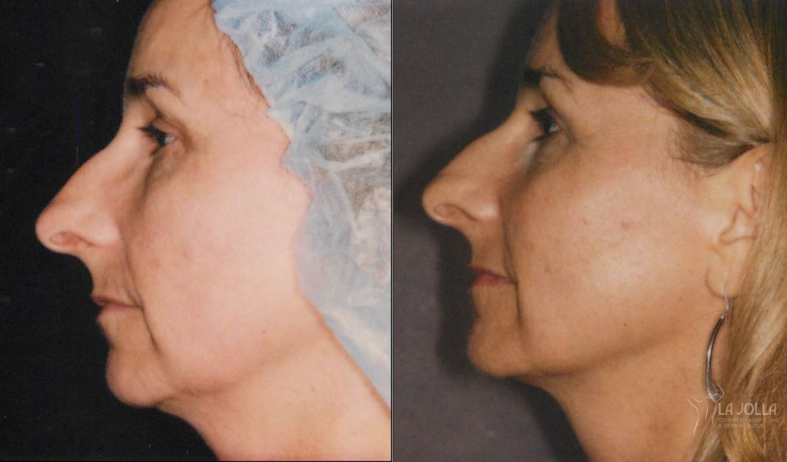 Before and after Thermage case 36207