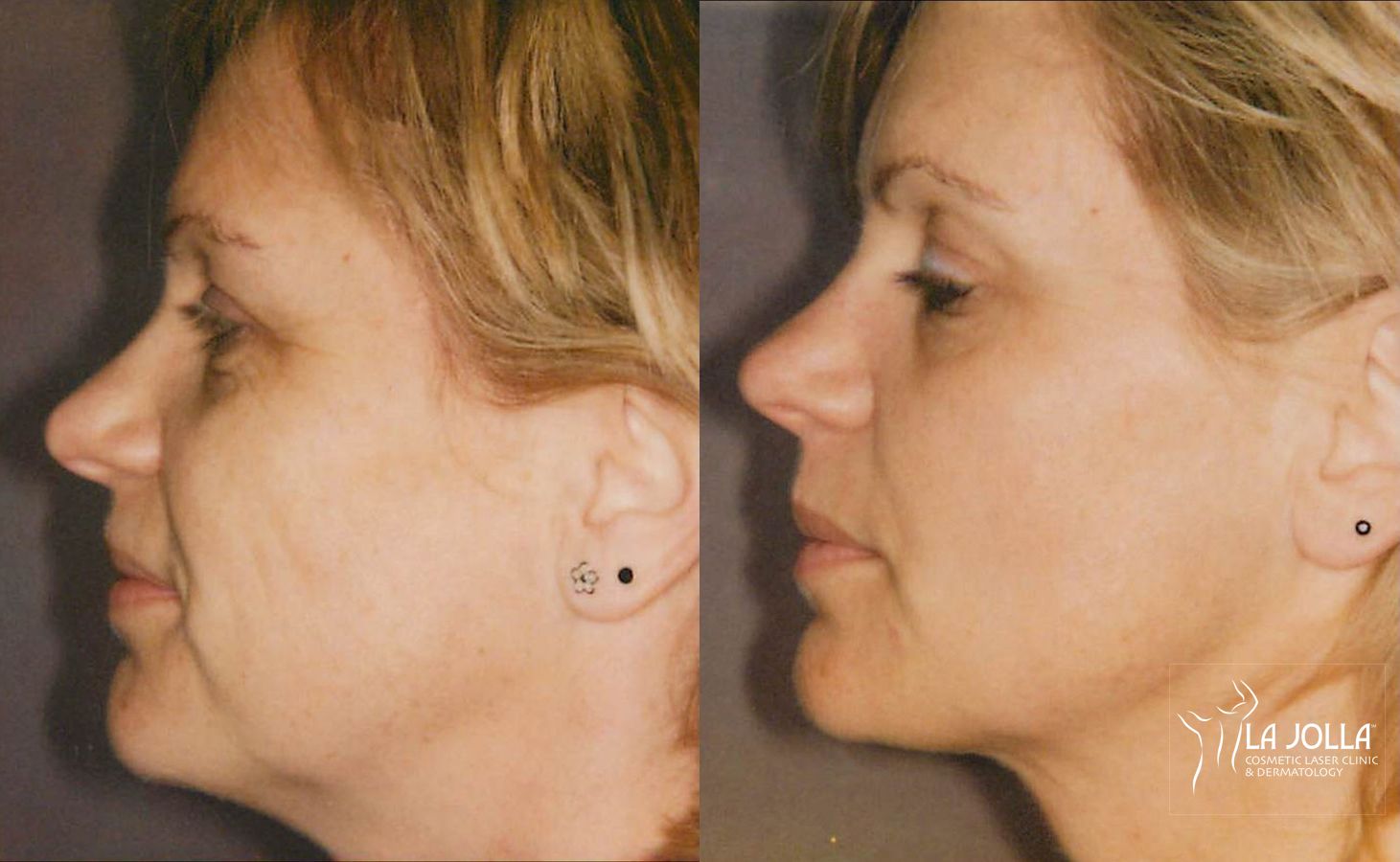 Before and after Thermage case 36107